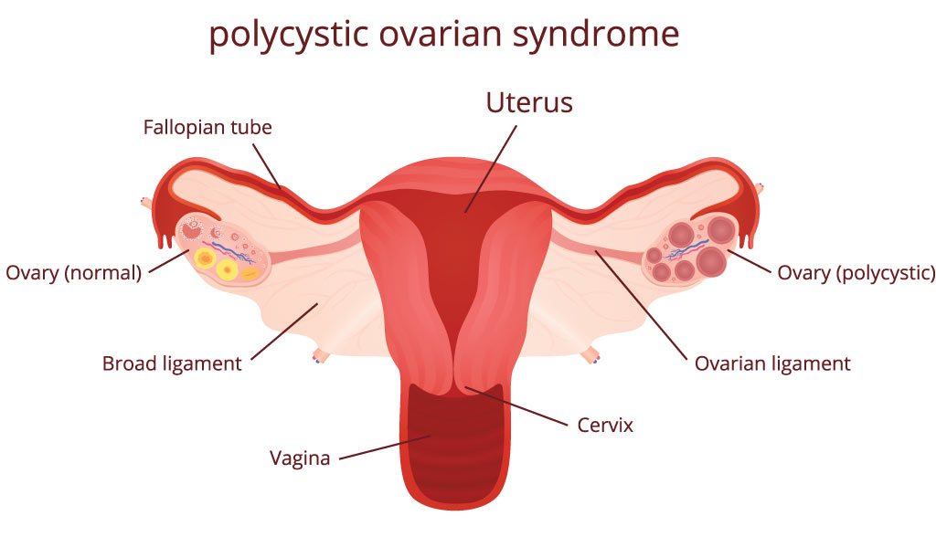 What is PCOS?