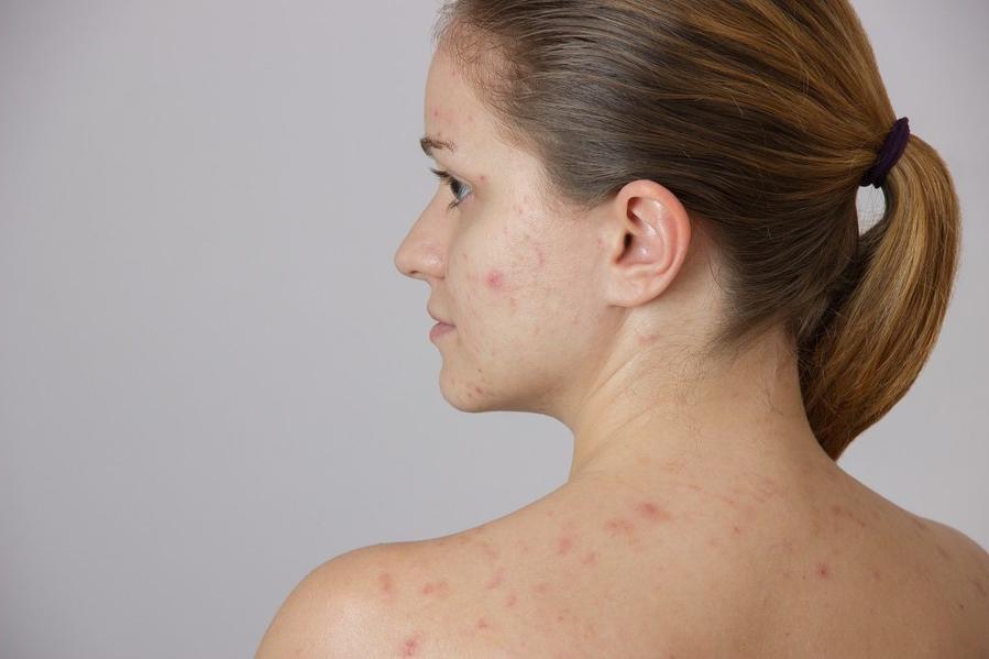 PCOS & Acne