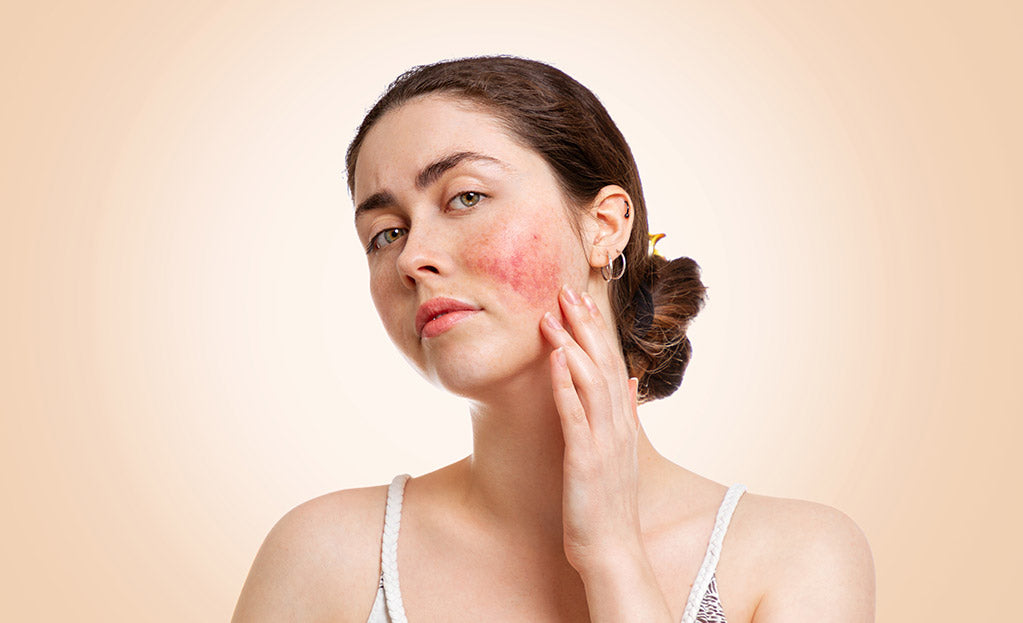 Top 5 Healing Foods for Inflamed Skin