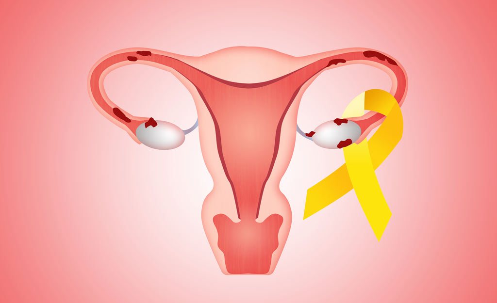 9 Steps to Treating Endometriosis