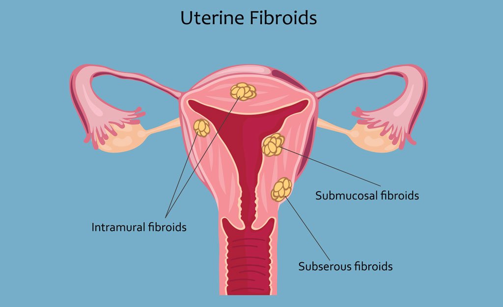 Fibroids: A Comprehensive Guide